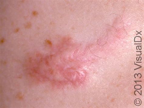 Keloid