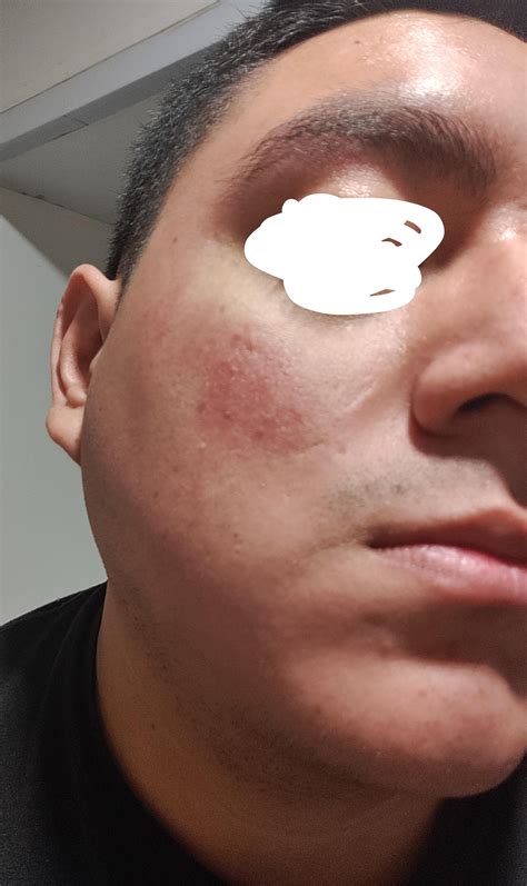 Red cheeks and pimples. : r/Skincare_Addiction