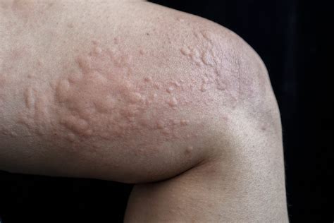 Chronic Spontaneous Urticaria or Chronic Hives | Oregon Medical ...