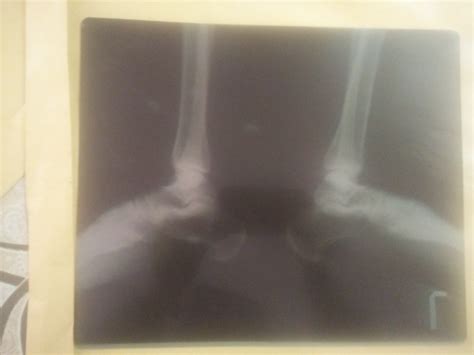 Ask a Radiologist Online for Calcaneal Spur
