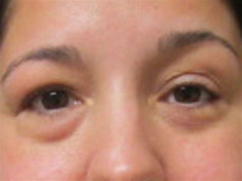 Surgery for Graves’ Disease Solves Woman’s Eye Problems