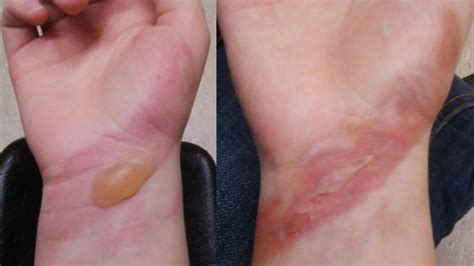 First Degree Burn First Aid