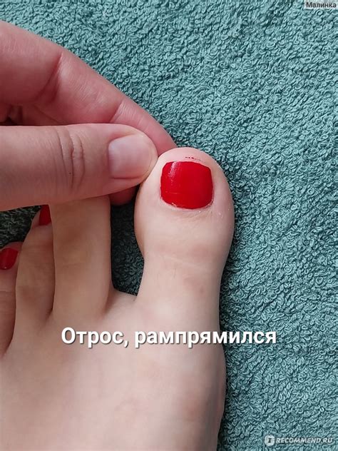 Коррекционная система вросшего ногтя. Титановая нить - «Добегалась - в ...