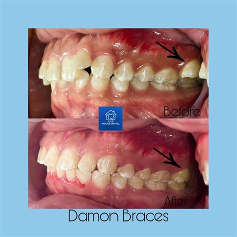 House - Scissor bite: Outward positioning of upper back teeth and