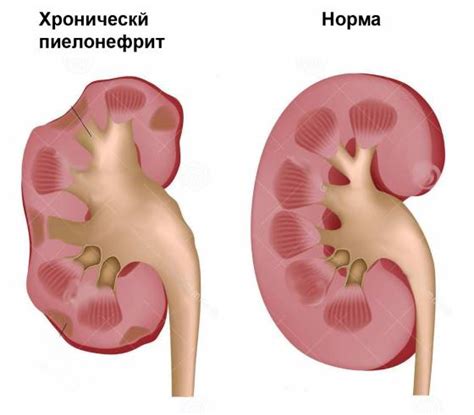 Отказ почек: симптомы, причины, сколько осталось жить