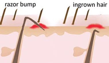 Laser Hair Removal For Ingrown Hairs - Simply Laser