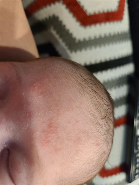 Milk bumps or rash/eczema? : r/Mommit