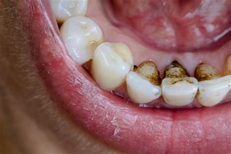 Black dental tartar - causes, associated symptoms, complications and ...