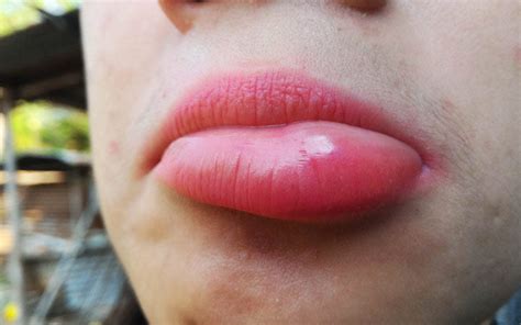 swollen lips  home remedies medical treatments precautions