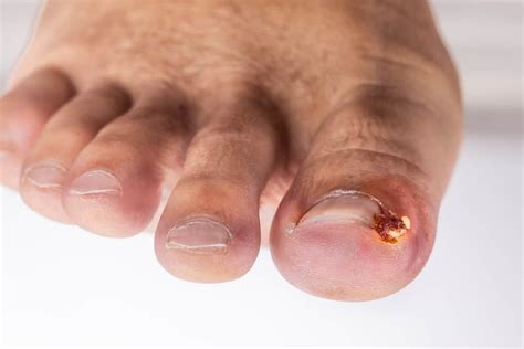 red toes   worry feet  clinic