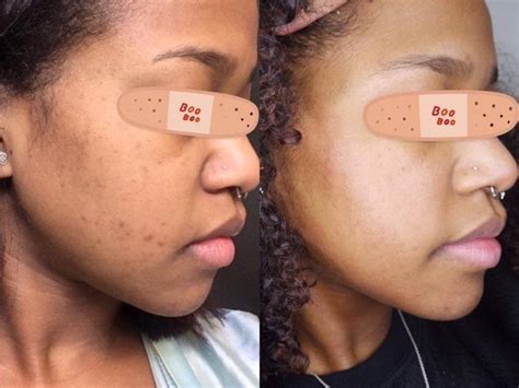 My PIH is Finally Clearing Up! [Before&After] : SkincareAddiction Diy ...