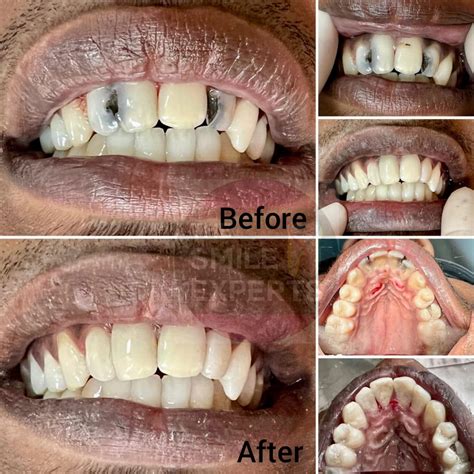 Gross interproximal decay of the anterior teeth, decay was carefully