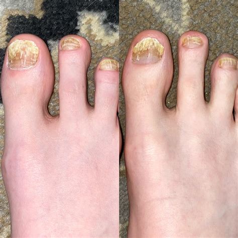 One Month Progress on Terbinafine (250mg/day) : r/NailFungus