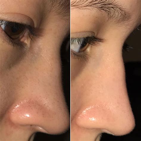 This Unbelievable Blackhead Removal 2024 Method Blew My Mind! Image 18