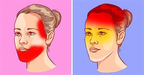 Мигрень. Что делать при частях головных болях?