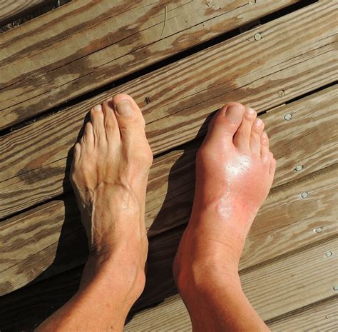 Gout Treatment | Gout Symptoms | Worthington Foot & Ankle