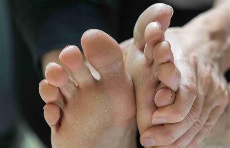 Understanding Pitted Keratolysis: Causes, Symptoms, and Treatment