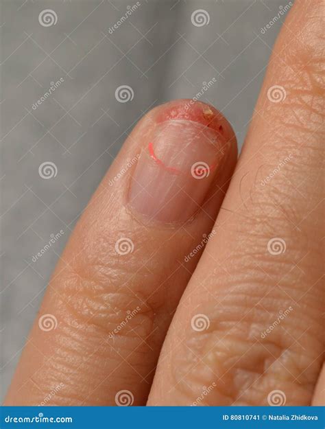 Too Grown Nail Gel-coated Break Off and Injure the Skin Under the Nail