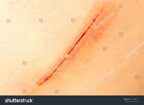 Wound On Human Body Scar Closeup Stock Photo 1154496115 | Shutterstock