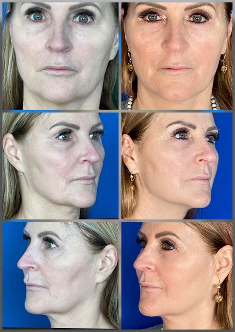 Sculptra Before & After Images • ReFresh Aesthetic Center, Whitefish Bay WI