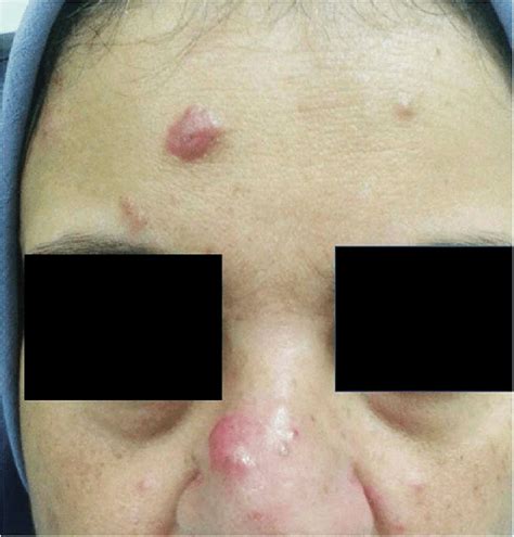 Skin Nodules