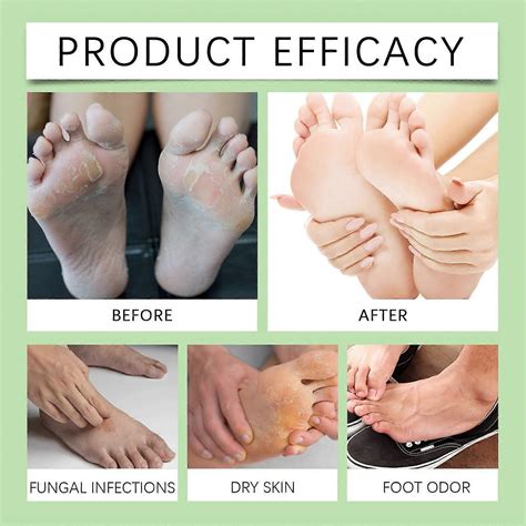 Bee Venom Fungi Vanish Foot Treatment Spray, Probiotic Foot Spray