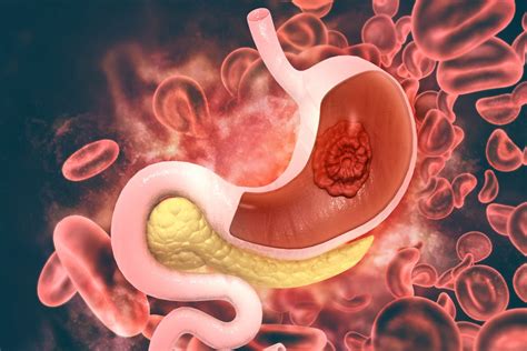 Gastric Problem
