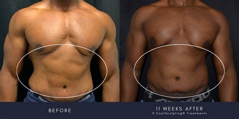 Does CoolSculpting® Work For Men? Everything You Need To Know: