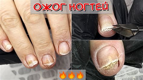 Ожог после лазерной эпиляции бикини фото