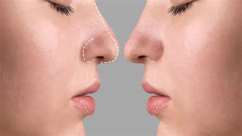 surgical rhinoplasty   shape     face