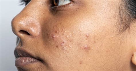 Acne Prone Skin: Taming Breakouts and Achieving Clarity - Abbasblogs
