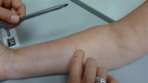 Tb Skin Test Flyer