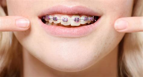 types  braces colors  kari gonzales blog