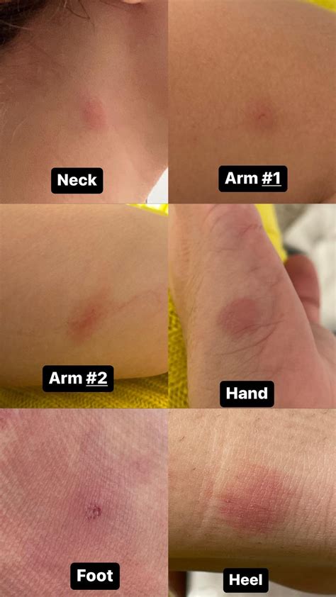 type  bite rbugidentification