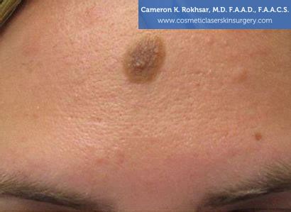 Congenital Nevus Removal Before And After