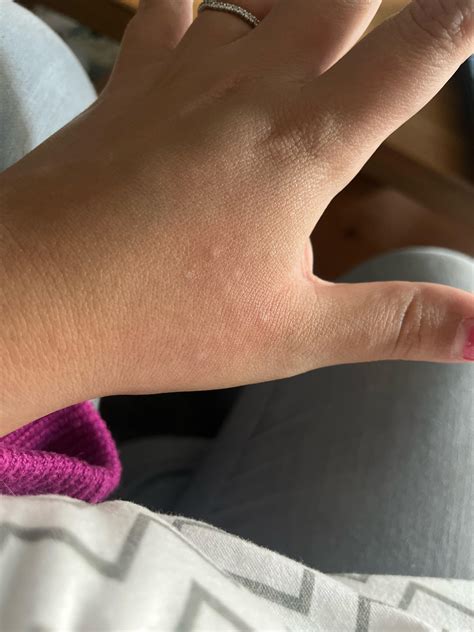 Rashes On Hands