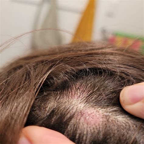 Itchy scalp rash/lesions : r/Dermatology