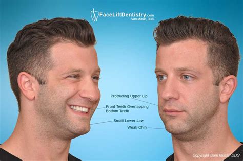How to Fix a Receding Chin Without Surgery - Tayler Strorge