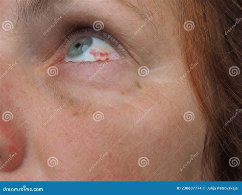 Subconjunctival Hemorrhage or Subconjunctival Bleeding, Hyposhagmus ...