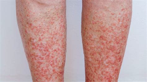 What Causes Polymorphic Light Eruption | Americanwarmoms.org