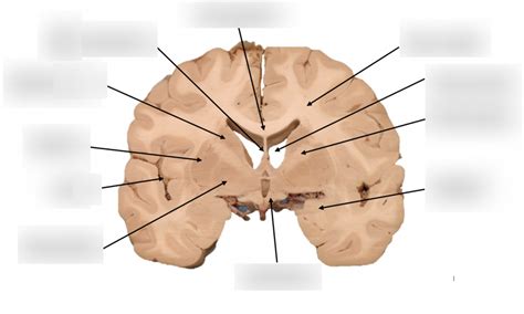diagram  brain coronal section quizlet
