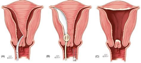 Longitudinal Vaginal Septum