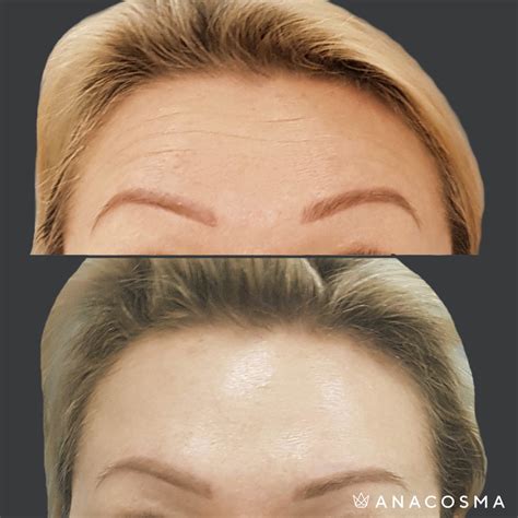 Ботокс для лица: цена на инъекции ботокса в Киеве ️ ANACOSMA