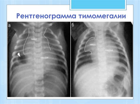 Вилочковая железа - презентация онлайн