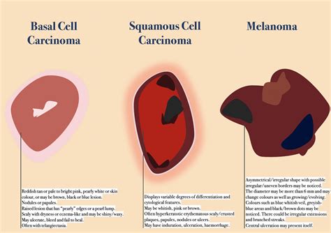 melanoma skin cancer types