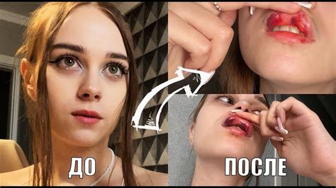 НЕУДАЧНОЕ увеличение губ - YouTube