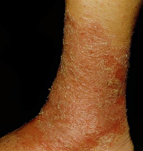 Stasis Dermatitis - Pictures, Symptoms, Causes, Treatment, Diagnosis ...