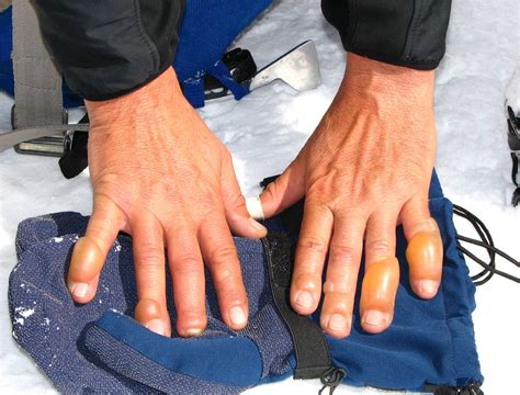 Arctic grip brings frostbite fears and other weather-related worries