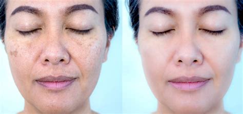 What Is Tri-luma Cream? Topical Therapy for Melasma | OKDERMO Skin Care