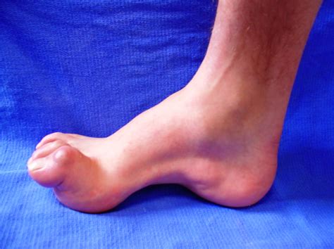 Charcot Marie Syndrome